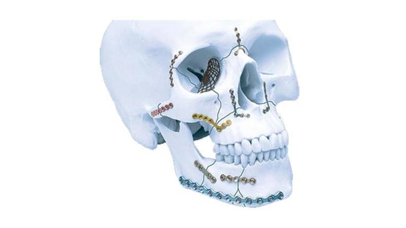 CMF System 1.5mm - Craniomaxillofacial Fixation