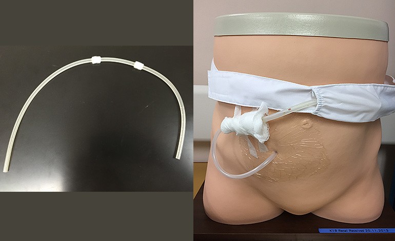 Tenckhoff catheter access — the surgical foundation of PD.