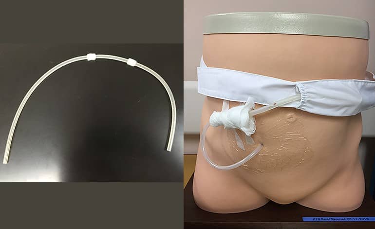 Tenckhoff catheter access — the surgical foundation of PD.